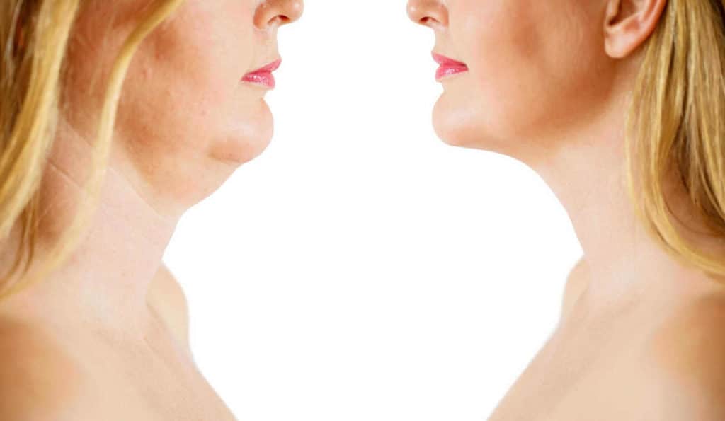 Double Chin treatment Pinner before and after results