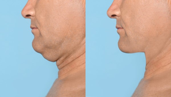 Which Non-Surgical Treatments Work Best for Jowls and Loose Skin Pinner?
