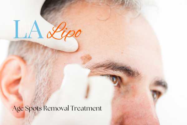 What Are the Most Effective Treatments for Age Spots Pinner?