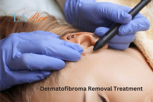 Dermatofibroma Removal Treatment Pinner