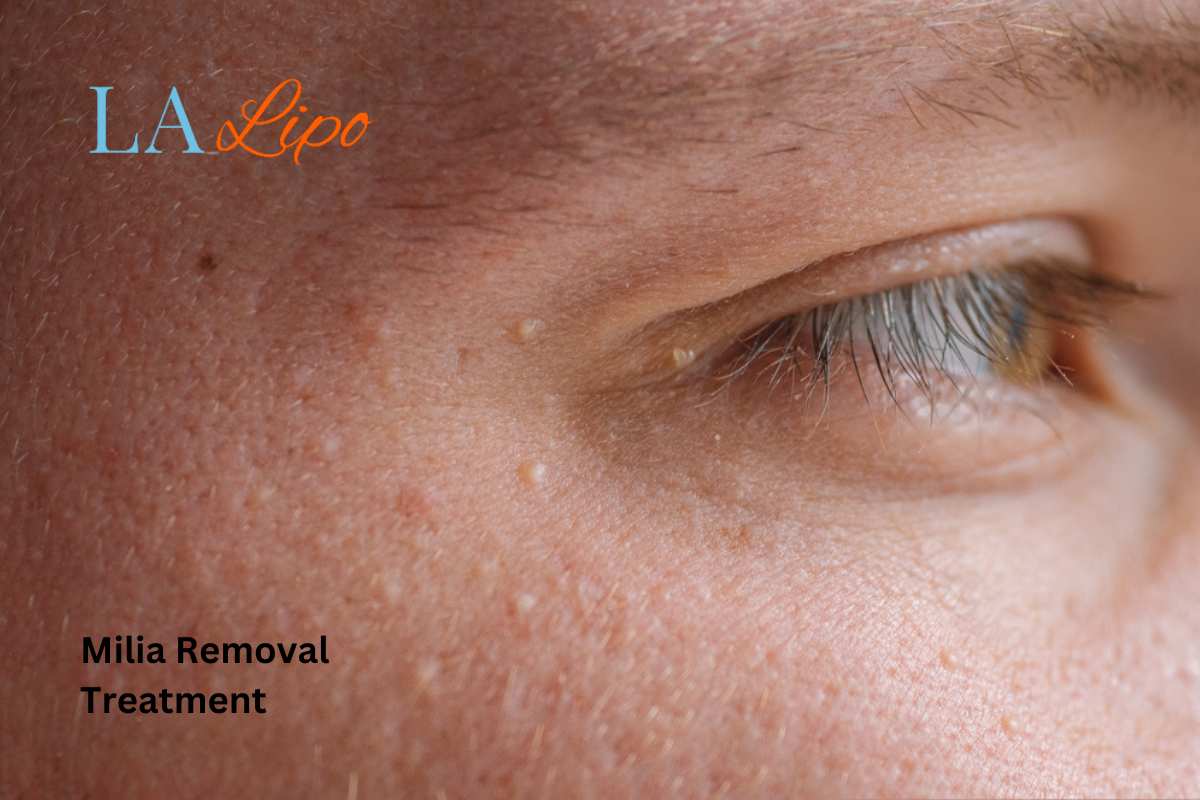 Cryopen Milia Removal: Is It the Easiest and Safest Option Pinner?