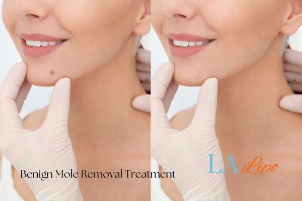 woman's before and after mole removal Pinner results