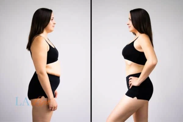 image of woman before and after results of LA-EMS Body Sculpting Pinner to help treat Diastasis recti