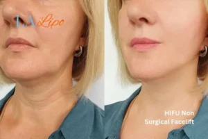 hi-fu for wrinkles Pinner before and after results