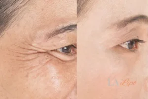 Before and after results of woman - HI-fu wrinkles reduction treatment Pinner