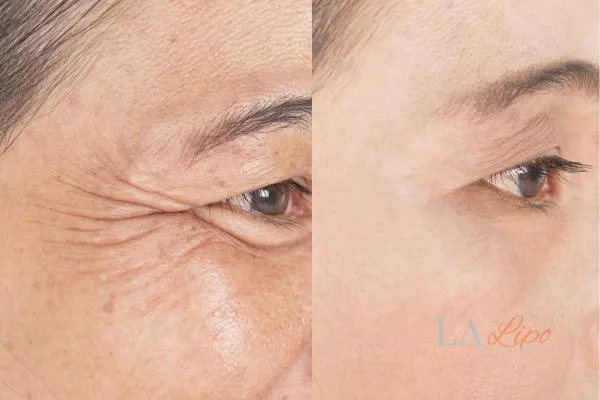 Before and after results of woman - HI-fu wrinkles reduction treatment Pinner