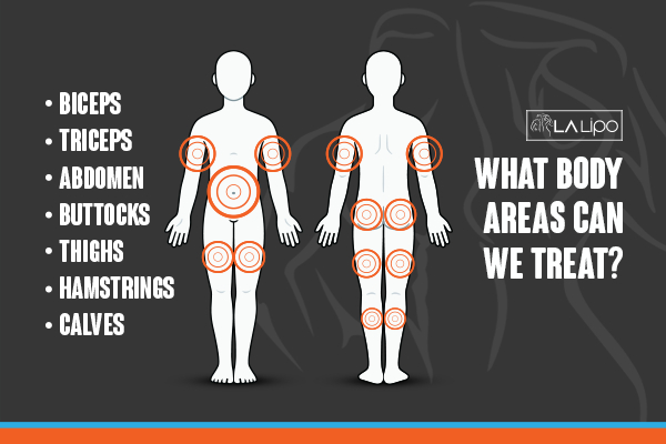 Graphic to show areas you can have LA-EMS Body Sculpting Pinner treatment.