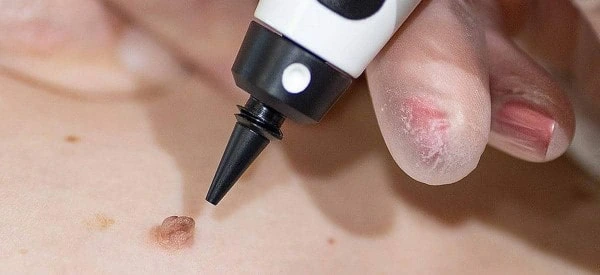 skin tag removal using cryopen Pinner