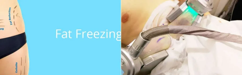 Fat freezing Pinner on multiple areas of the body