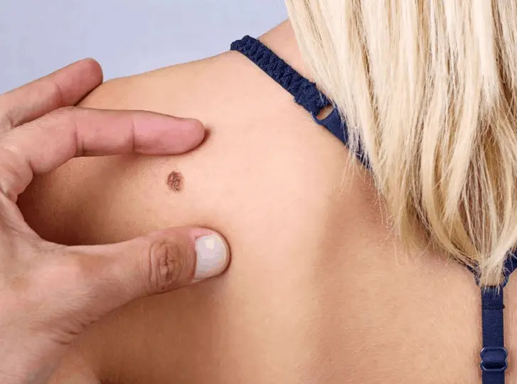 woman having mole removal Pinner consultation before treatment.