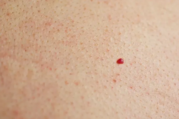 close up of a cherry angioma Pinner