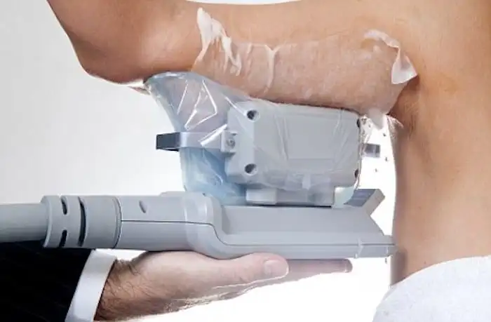 Picture of fat freezing Pinner on the upper arms.