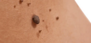 image of a skin tag Pinner