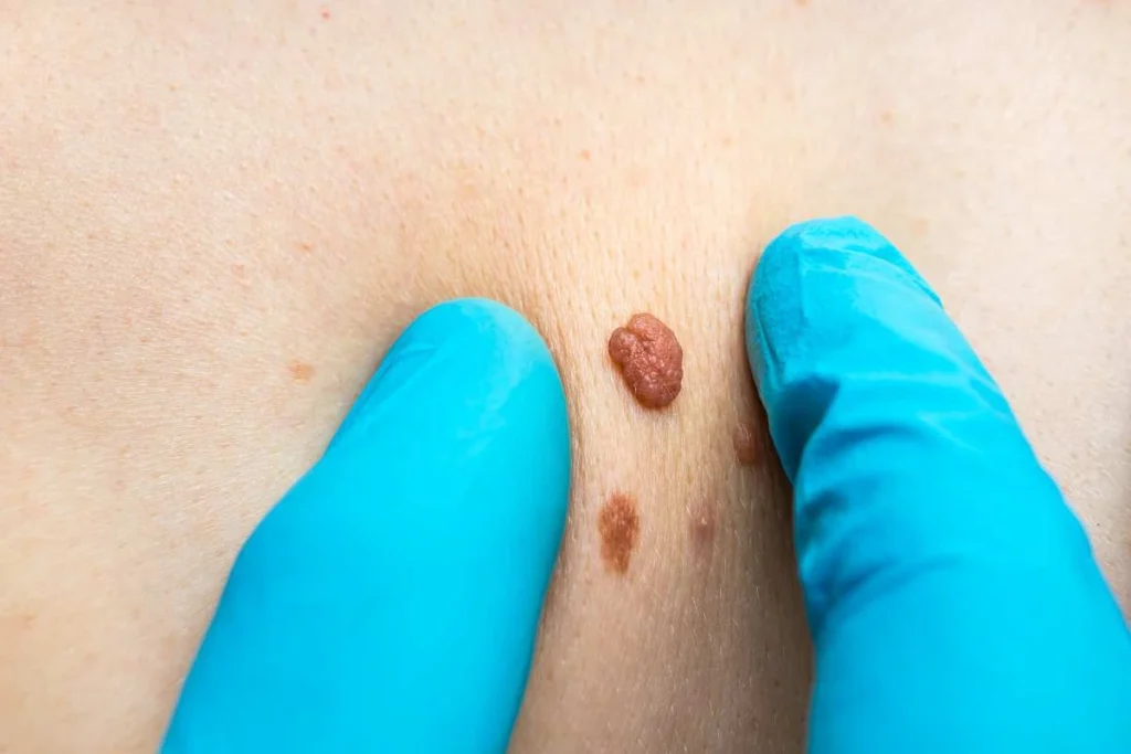 Consultant examining a skin tag Pinner