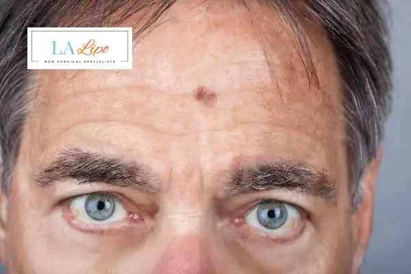 Solar Lentigo Removal Pinner image of man with mark on his forehead