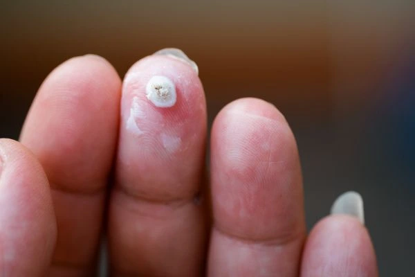 wart on person finger - cryotherapy to treat from LA LIPO Pinner