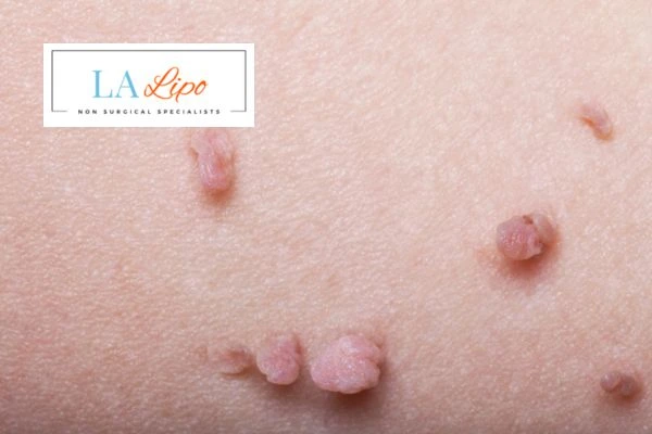 Does cryopen skin tag removal Pinner hurt? Find out now call our team today!