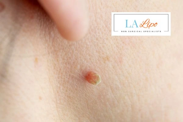 Book skin tag removal Pinner today speak to our team now!