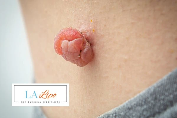 Interested in skin tag removal Pinner? Concerned about the pain? Find out more today!