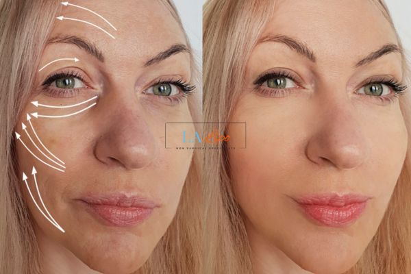 Morpheus 8 results Pinner face lift.