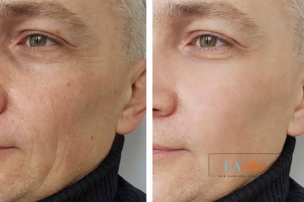 See the amazing results of Morpheus8 Treatment Pinner!