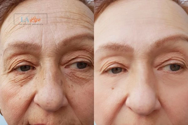 The powerful benefits of Morpheus8 Treatment Pinner - Call Our team today!