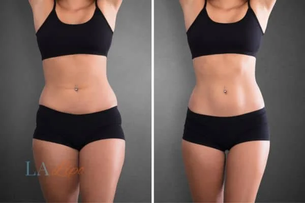 before and after results of non-surgical treatment to help a woman's body image and mental health Pinner