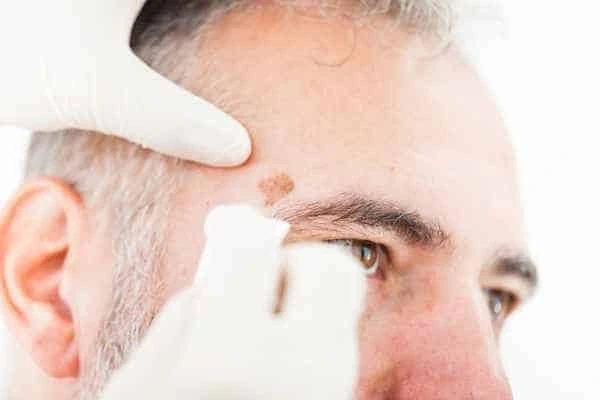 Age spots and elderly people Pinner what is the link?