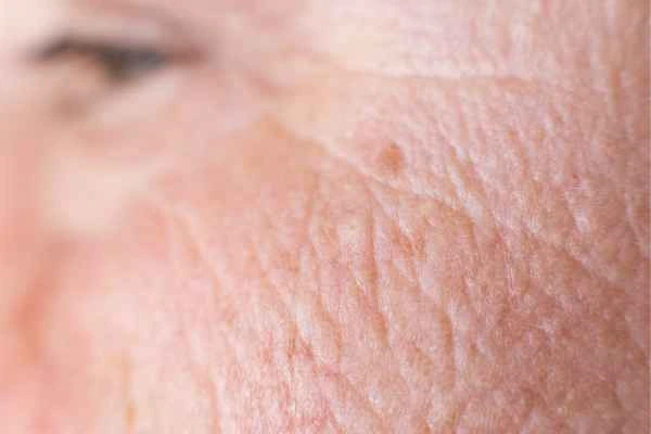 close up picture of a woman's face showing an age spot Pinner
