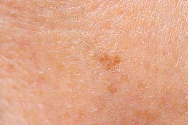close up picture of age spots Pinner