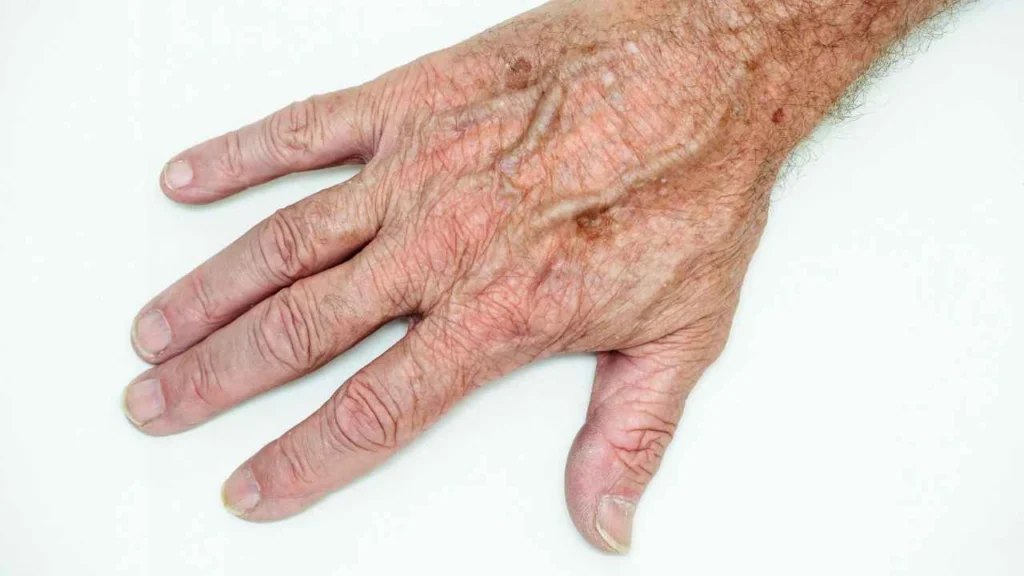 Male hand showing age spot Pinner