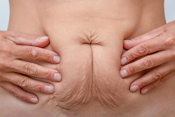 Image of a woman's stomach with loose skin - example of skin tightening Pinner options