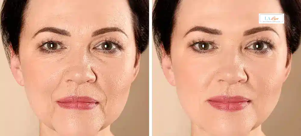 How Long Does It Take to See Results and How Long Do They Last Pinner?