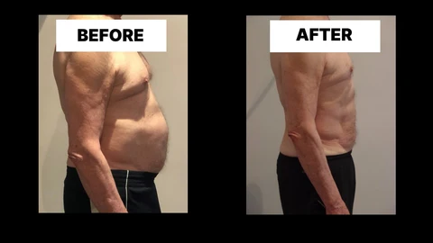 What Symptoms Can Diastasis Recti Cause in Men? Weak Core, Back Pain and Poor Posture Pinner